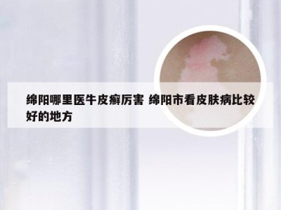 绵阳哪里医牛皮癣厉害 绵阳市看皮肤病比较好的地方