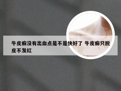 牛皮癣没有出血点是不是快好了 牛皮癣只脱皮不发红