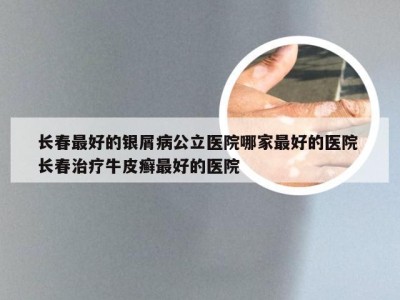 长春最好的银屑病公立医院哪家最好的医院 长春治疗牛皮癣最好的医院