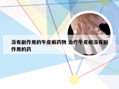 没有副作用的牛皮癣药物 治疗牛皮癣没有副作用的药