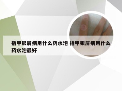 指甲银屑病用什么药水泡 指甲银屑病用什么药水泡最好