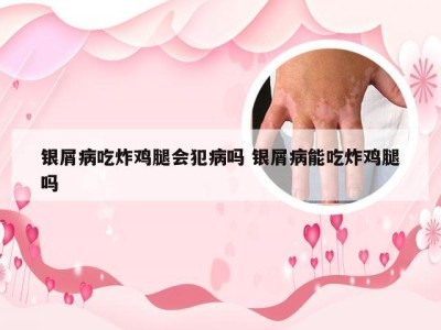 银屑病吃炸鸡腿会犯病吗 银屑病能吃炸鸡腿吗