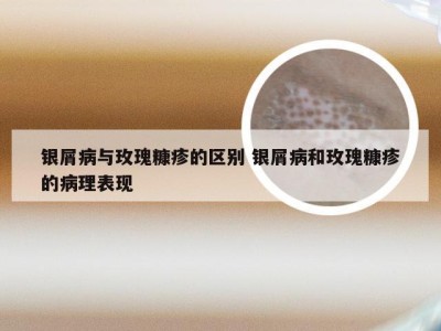 银屑病与玫瑰糠疹的区别 银屑病和玫瑰糠疹的病理表现