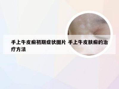 手上牛皮癣初期症状图片 手上牛皮肤癣的治疗方法