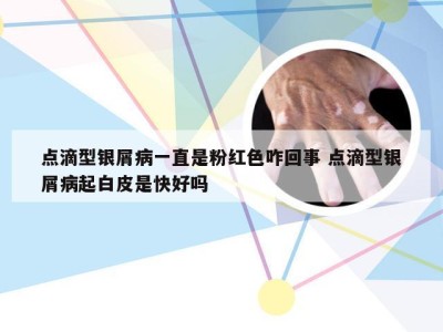 点滴型银屑病一直是粉红色咋回事 点滴型银屑病起白皮是快好吗