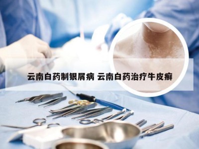 云南白药制银屑病 云南白药治疗牛皮癣
