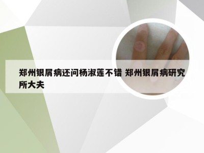 郑州银屑病还问杨淑莲不错 郑州银屑病研究所大夫