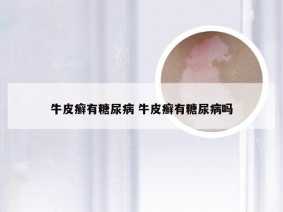 牛皮癣有糖尿病 牛皮癣有糖尿病吗