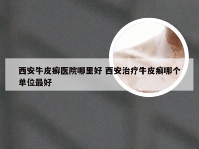 西安牛皮癣医院哪里好 西安治疗牛皮癣哪个单位最好