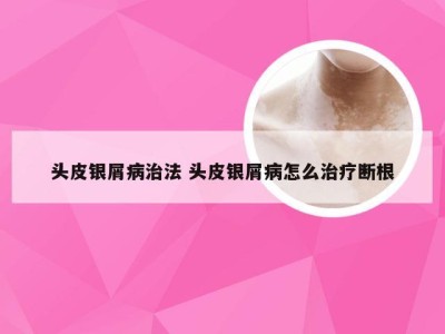 头皮银屑病治法 头皮银屑病怎么治疗断根