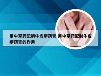 用中草药配制牛皮癣药膏 用中草药配制牛皮癣药膏的作用