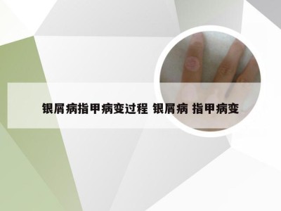 银屑病指甲病变过程 银屑病 指甲病变