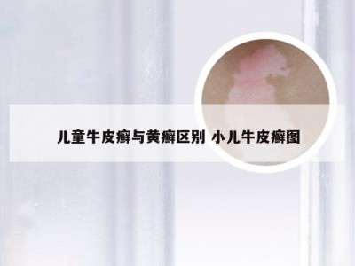 儿童牛皮癣与黄癣区别 小儿牛皮癣图