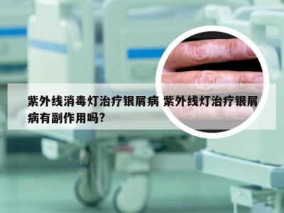 紫外线消毒灯治疗银屑病 紫外线灯治疗银屑病有副作用吗?