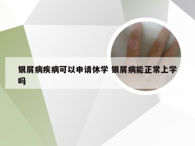 银屑病疾病可以申请休学 银屑病能正常上学吗