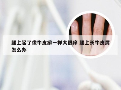 腿上起了像牛皮癣一样大很痒 腿上长牛皮屑怎么办