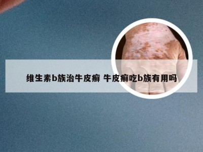 维生素b族治牛皮癣 牛皮癣吃b族有用吗