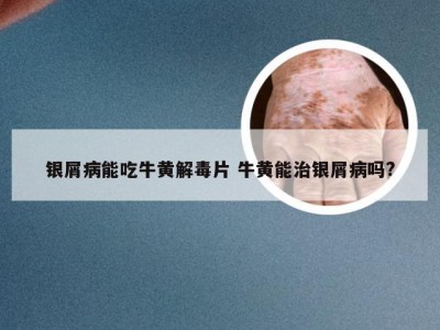 银屑病能吃牛黄解毒片 牛黄能治银屑病吗?