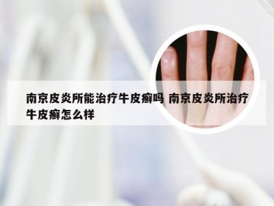 南京皮炎所能治疗牛皮癣吗 南京皮炎所治疗牛皮癣怎么样