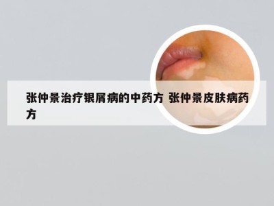 张仲景治疗银屑病的中药方 张仲景皮肤病药方