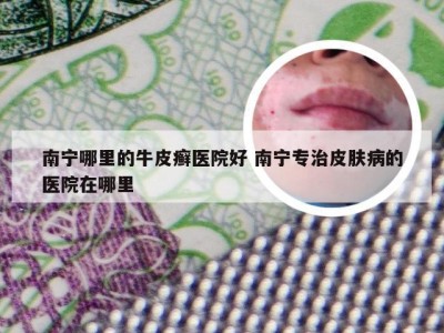 南宁哪里的牛皮癣医院好 南宁专治皮肤病的医院在哪里