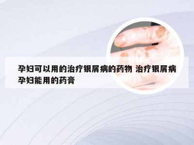 孕妇可以用的治疗银屑病的药物 治疗银屑病孕妇能用的药膏