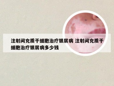 注射间充质干细胞治疗银屑病 注射间充质干细胞治疗银屑病多少钱