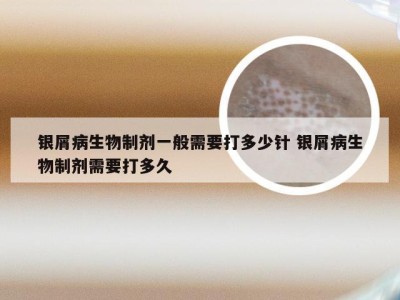 银屑病生物制剂一般需要打多少针 银屑病生物制剂需要打多久