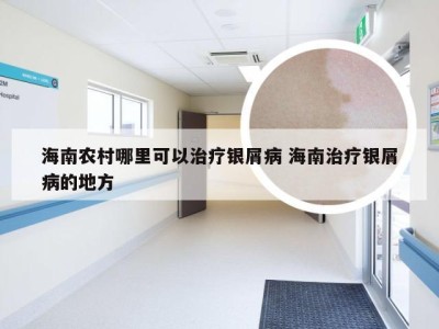 海南农村哪里可以治疗银屑病 海南治疗银屑病的地方