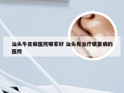 汕头牛皮癣医院哪家好 汕头有治疗银屑病的医院