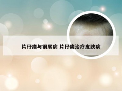 片仔癀与银屑病 片仔癀治疗皮肤病