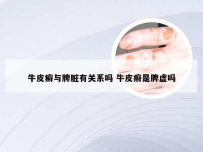 牛皮癣与脾脏有关系吗 牛皮癣是脾虚吗