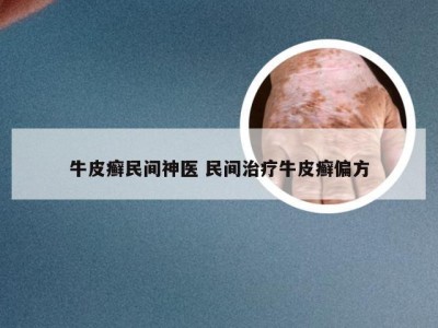 牛皮癣民间神医 民间治疗牛皮癣偏方