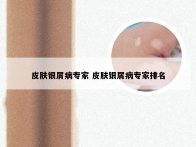皮肤银屑病专家 皮肤银屑病专家排名