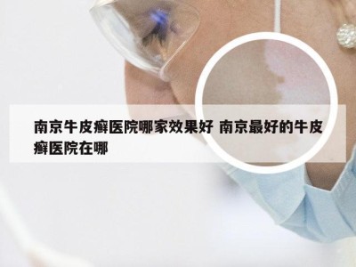 南京牛皮癣医院哪家效果好 南京最好的牛皮癣医院在哪