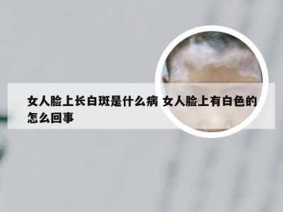 女人脸上长白斑是什么病 女人脸上有白色的怎么回事