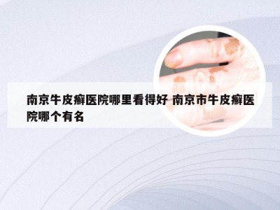 南京牛皮癣医院哪里看得好 南京市牛皮癣医院哪个有名