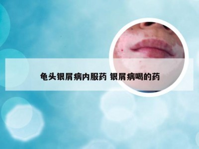 龟头银屑病内服药 银屑病喝的药