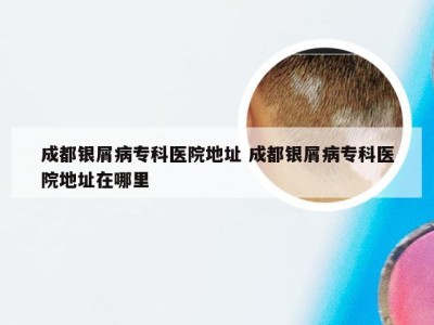 成都银屑病专科医院地址 成都银屑病专科医院地址在哪里