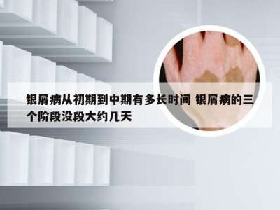 银屑病从初期到中期有多长时间 银屑病的三个阶段没段大约几天
