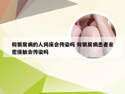和银屑病的人同床会传染吗 和银屑病患者亲密接触会传染吗