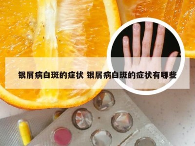 银屑病白斑的症状 银屑病白斑的症状有哪些