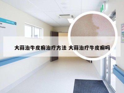 大蒜治牛皮癣治疗方法 大蒜治疗牛皮癣吗