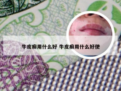 牛皮癣用什么好 牛皮癣用什么好使