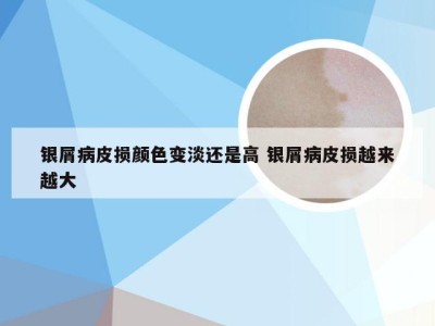 银屑病皮损颜色变淡还是高 银屑病皮损越来越大