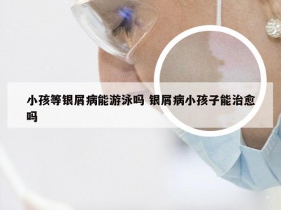 小孩等银屑病能游泳吗 银屑病小孩子能治愈吗