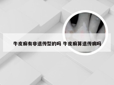 牛皮癣有非遗传型的吗 牛皮癣算遗传病吗