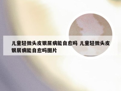 儿童轻微头皮银屑病能自愈吗 儿童轻微头皮银屑病能自愈吗图片