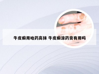 牛皮癣用哈药高抹 牛皮癣涂药膏有用吗