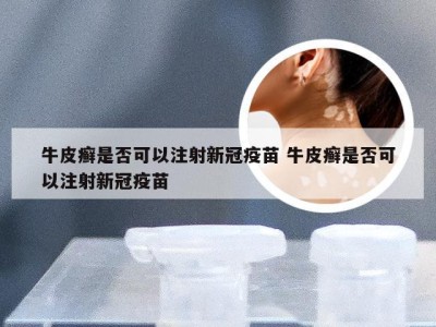 牛皮癣是否可以注射新冠疫苗 牛皮癣是否可以注射新冠疫苗